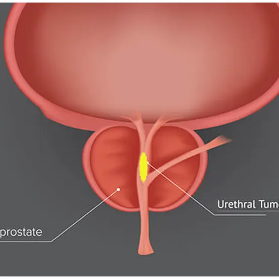 urethral cancer package test